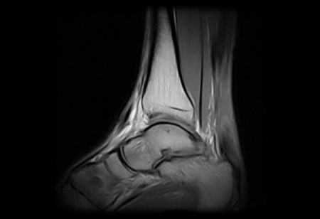 Az Achilles ín szakadása bevérzéssel