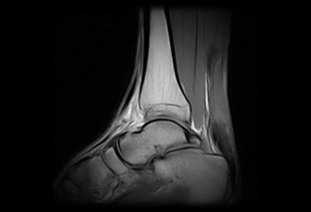 Az Achilles ín szakadása