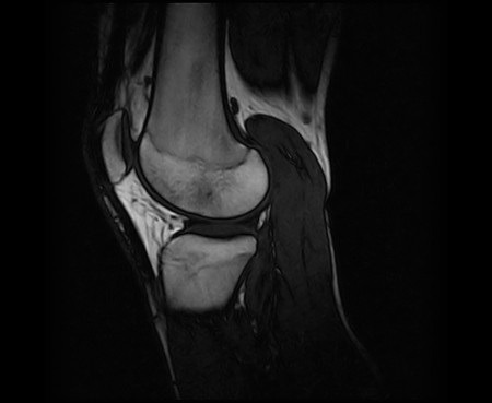 Xbone sagittal