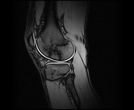 Porckopás a femur lateralis részén